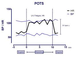 Image result for Head-Up Tilt-Table Testing