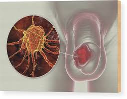 Image result for Penile Cancer