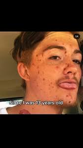 Recovery is possible #fyp #share #awareness