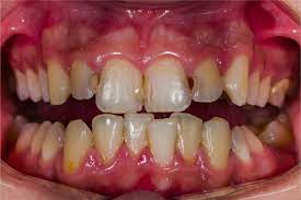 Almost every single one of my teeth is decaying and bad. Methods On How To Cover A Cavity On Front Tooth Trancy Net