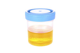 Air kencing adalah bahan kumbahan cecair badan yang disingkir oleh buah pinggang melalui proses penapisan dari darah yang dikenali sebagai kencing dan dikeluarkan melalui urethra. Ini Arti 11 Macam Warna Air Pipis Dan Penjelasan Medisnya Cek Punyamu