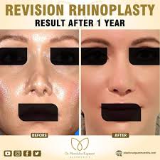 Best Rhinoplasty Surgeon Delhi Nose Plastic Surgeon India In 2020 Rhinoplasty Rhinoplasty Surgeon Rhinoplasty Surgery
