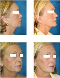 Prix à titre indicatif, les honoraires peuvent varier d'un praticien à l'autre. Lifting Visage Tunisie Prix Lifting Cervico Facial