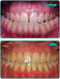 Search for health information from across the web with discoverhealthinfo.com. Leader In Us Quality Dental Braces Tourism In Nuevo Progreso Mexico Meet Us Patient Info Treatments Braces Article Contact Us Treatment Orthodontic Preventive Care Treatment For Children Treatment For Adults Teeth And Face Classifications Tmj