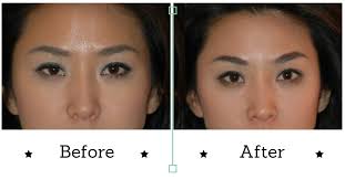 Patients with sleepy eyes have a condition called . Dr Vanessa Neoh Temporal Face Brow Lift In Penang