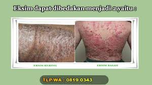 Pin Di Gatal Kulit