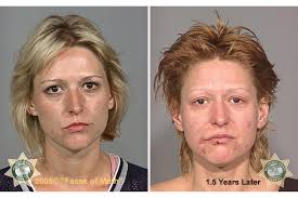 Drogenkonsum: Das schreckliche Gesicht von Crystal Meth