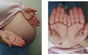 Palmoplantar erythrodysesthesia (acral erythema) because circulating levels of estrogen increase in both cirrhosis and pregnancy, estrogen was thought to be the main cause for the increased vascularity. Cosmetic Aspects Of Pregnancy Sciencedirect