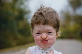 Girl with one-in-a-million condition has skull rearranged like jigsaw in  £3m treatment