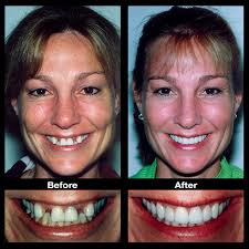 What is the best way to fix spaces or gaps in teeth? Fix Gap Spaces Teeth Bands Oppenheim Signature Smiles