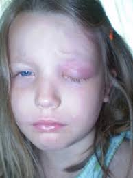 Wilkins Alaska: Ava was diagnosed with Langerhans Cell Histiocytosis (LCH)