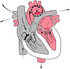 Patent Ductus Arteriosus Pediatric Nursing Ductus Arteriosus Patent Ductus Arteriosus