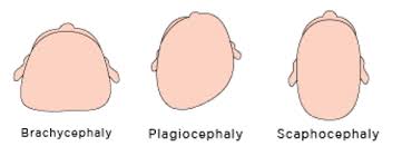ما هو تشوّه الرأس عند الأطفال؟