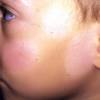 Pityriasis alba is a benign and common skin disorder commonly affecting children and young adults. 1