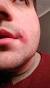 Ingrown Hair On Lip Pictures
