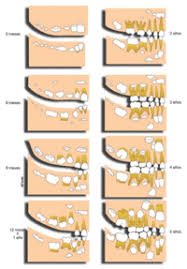 teething wikipedia