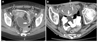 Two Different Vp Shunt Patients A And B Presented With Symptoms Of Download Scientific Diagram