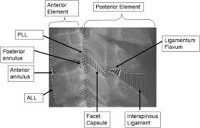 Image result for Subaxial Injury Classification Scale
