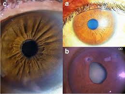 Read an overview of general eye anatomy to learn how the parts of the eye work together. A Normal Eye Showing Iris Morphology B Entropion Uvea Note The Pupil Download Scientific Diagram