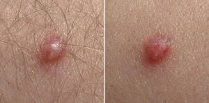 Image result for genital warts