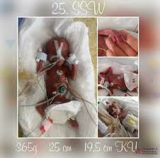 Mein erstes baby, ultraschall in der 19 ssw und es wird ein junge. Fruhchenwunder Mit 25 Wochen Sternenzauber Fruhchenwunder E V
