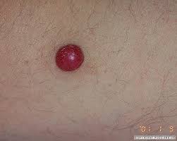 Image result for Pyogenic Granuloma