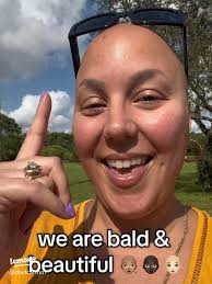 Embracing Baldness: My Journey with Alopecia
