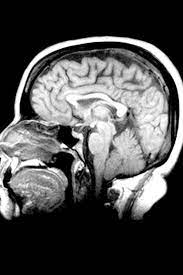 Were Ancient Mystics Onto Something Review Of Norman Doidge S The Brain S Way Of Healing Mri Mystic Ancient