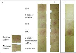It's important to perform an allergy alert test each time you colour your hair, even if you've used at home hair dye before and had no reaction, as skin can develop an allergy over time. The Results Of Skin Prick Testing With Ingredients Of The Hair Dye A Download Scientific Diagram