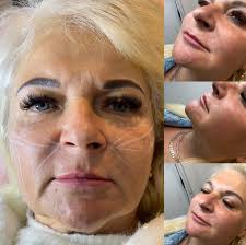 Wow! My friend Jennifer's Neo-Filler results🥹😳 No needles. No downtime.  No joke. Just a topical treatment that tells your skin to plump and fill  itself—without injections. This isn't some run-of-the-mill cream. It's