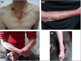 Pellagra is a condition that develops from niacin deficiency (vitamin b3). 5o Ppriwkqhym