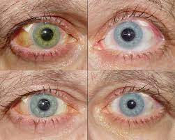 Located in sarasota, bradenton, lakewood ranch and sun city center. Iris Colour Change After Glaucoma Surgery Associated With Haemorrhagic Choroidal Effusion Eye