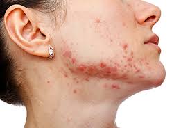 How to transition off the birth control pill. Stubborn Acne Hormonal Therapy May Help