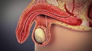 Snyder says the best way to address erectile dysfunction depends on whether the problem is temporary or recurring. Erectile Dysfunction Wikipedia