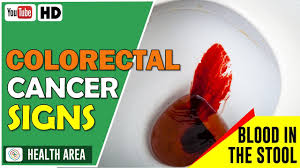 If you notice blood in your stool, this could be a telltale sign of colon cancer. 6 Early Signs Of Colorectal Cancer Youtube