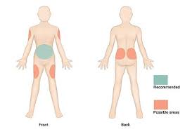 Tips For Insulin Injection Site Rotation