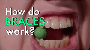 During a second consultation with a different orthodontist, i was recommended traditional braces. How Much Do Braces Cost For Adults And Teens Find Out Now