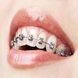 Metal Braces