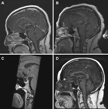 Does Pituitary Compression Empty Sella Syndrome Contribute To Mri Negative Cushing S Disease A Single Institution Experience In Neurosurgical Focus Volume 48 Issue 6 2020