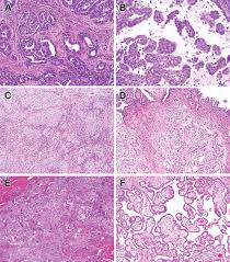 Previous imaging reports of peritoneal mesothelioma have described a variety of radiologic appearances,. Mesothelioma Pathology Springerlink