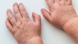 Image result for Scarlet Fever