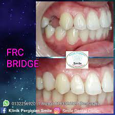 Using this technique, it is. Frc Bridge Gigi Palsu Express Klinik Pergigian Smile Facebook