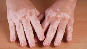 There are a few reasons for this. Vitiligo Causes And Treatment Of Skin Pigment Loss