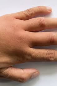 To keep nails healthy, hydrate them and minimize the use of harsh chemicals and tools. What Are The Causes Of Swollen Hands