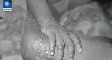 The spots often start on the face before spreading to other parts of the body. Facts About Monkey Pox Disease Channels Television