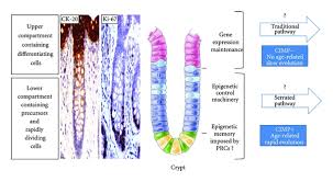 Pin By Cancer Hallmarks On Colon Cancer Colon Cancer Cancer Differentiation