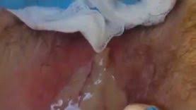 Largest pimple ever recorded biggest pimple ever popped on earth worlds biggest zit popped 2010 original big zit popping youtube 2017 best pimple pop ever youtube pimple explosion zit popping youtube 2015 biggest click here for the biggest archive of popping videos. Biggest Pimple Pop Ever Seen 2017 Caught On Camera Guiness World Record S Biggest Pimple Ever Pimple Popping Videos