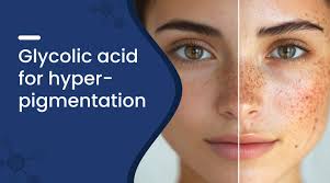 Glycolic Acid For Hyperpigmentation ...