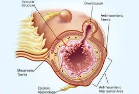 Image result for Diverticulitis