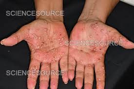Image result for Pustular Psoriasis